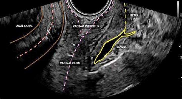 Can a rough ultrasound cause miscarriage?
