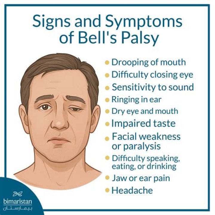 Can depression cause Bell's palsy?