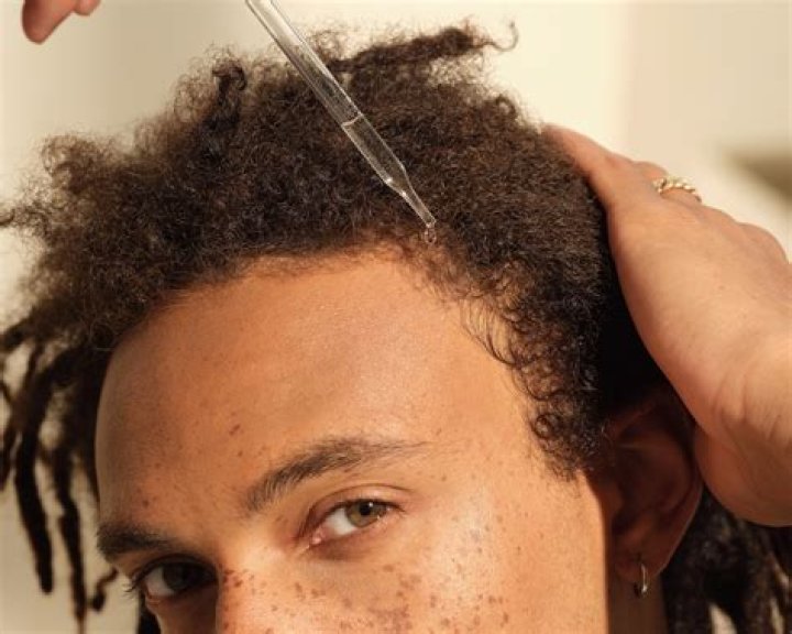 Can dreads stop hair loss?