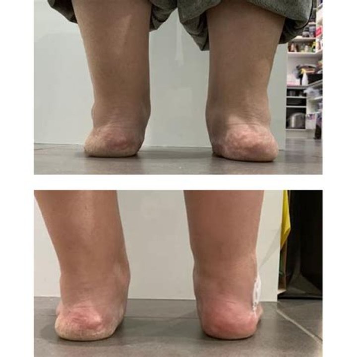 Can flat feet be developed?