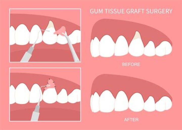 Can I drink Coke after gum surgery?
