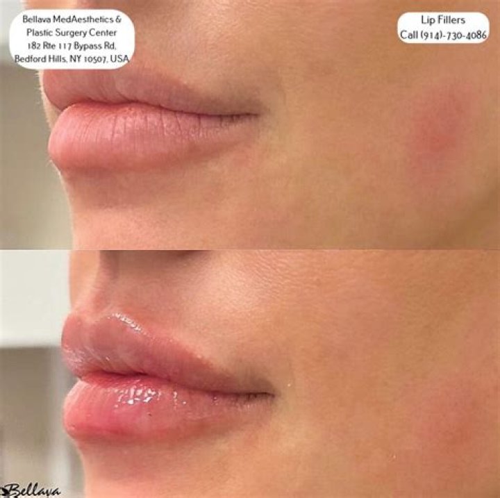 Can I get more lip filler after 1 week?