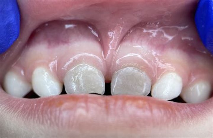 Can kids teeth turn grey?