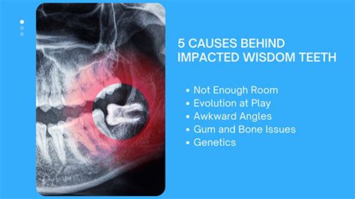 Can wisdom teeth press on nerves?