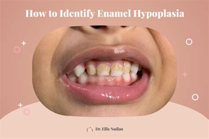 Can you get rid of enamel hypoplasia?