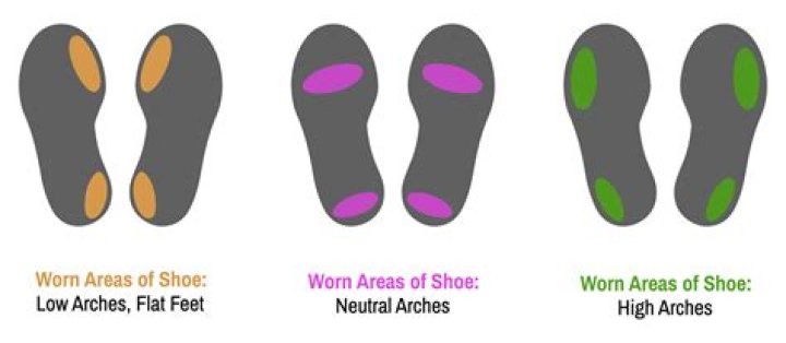 Can you rebuild arches in flat feet?