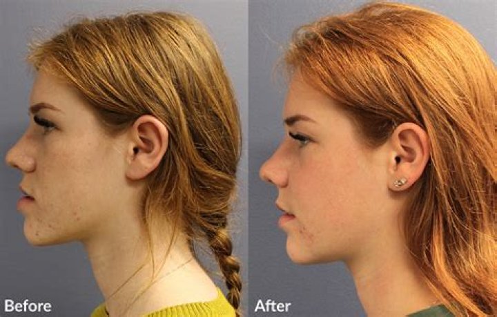 Does overbite affect jawline?