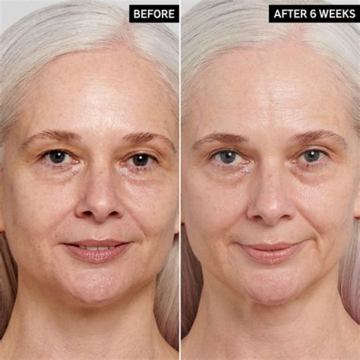 Does retinol help with marionette lines?
