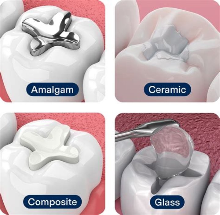 How can a dentist mess up a filling?