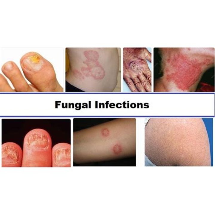 How do I know if I have a dermatofibroma?