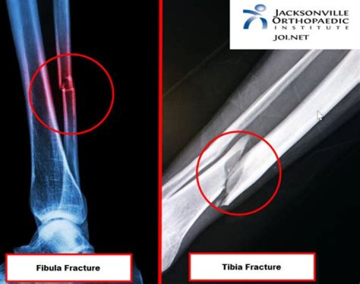 How do you diagnose a fibula fracture?