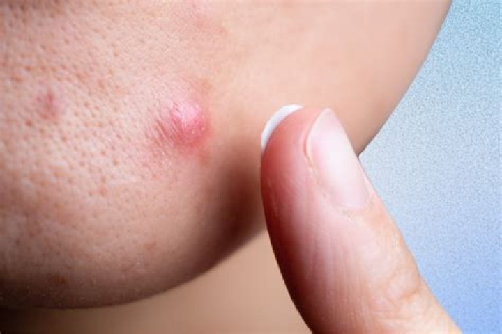 How do you flatten a cystic pimple?