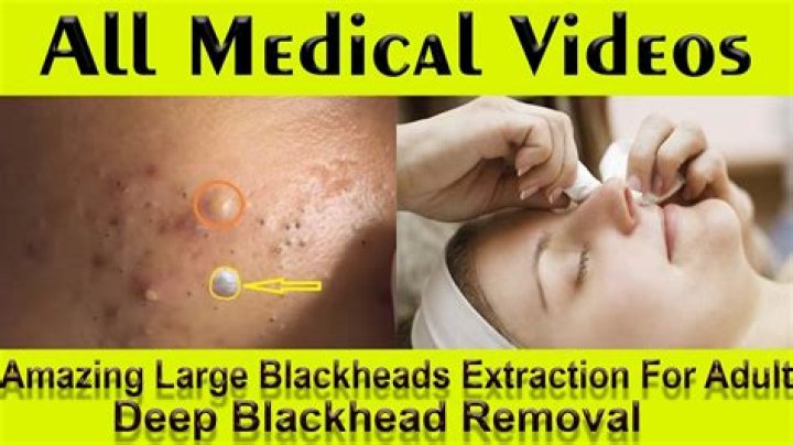 How do you pop a large blackhead?