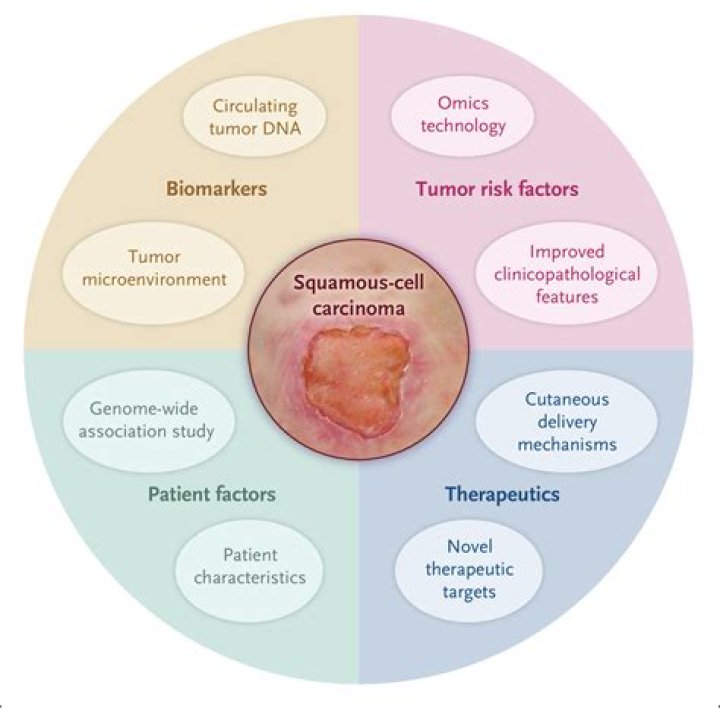 How does a squamous cell carcinoma start?