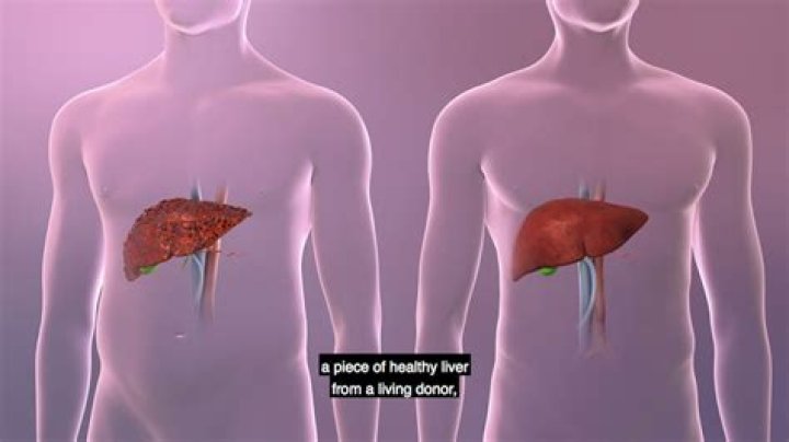 How long can you live without a liver?
