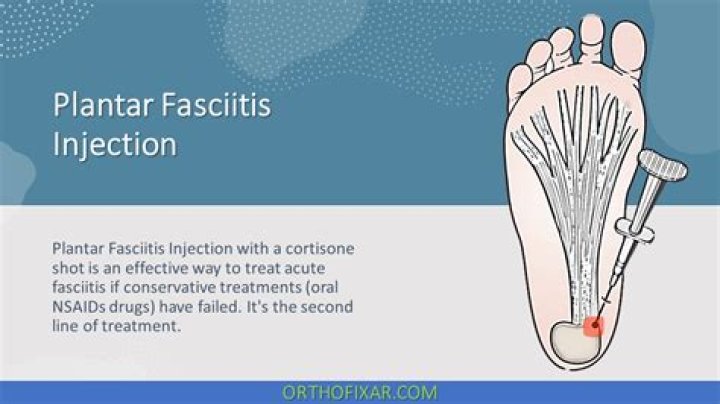 How long does cortisone shot last for plantar fasciitis?