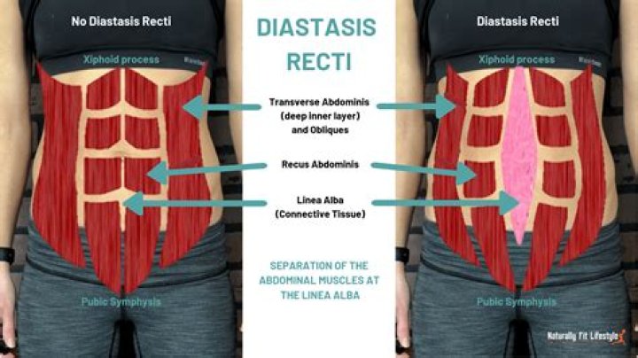 How long does diastasis recti last after pregnancy?