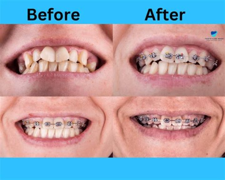 How long will braces hurt after tightening?