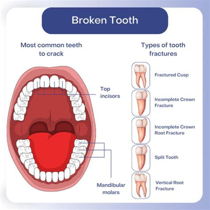 How much force does it take to break a tooth?