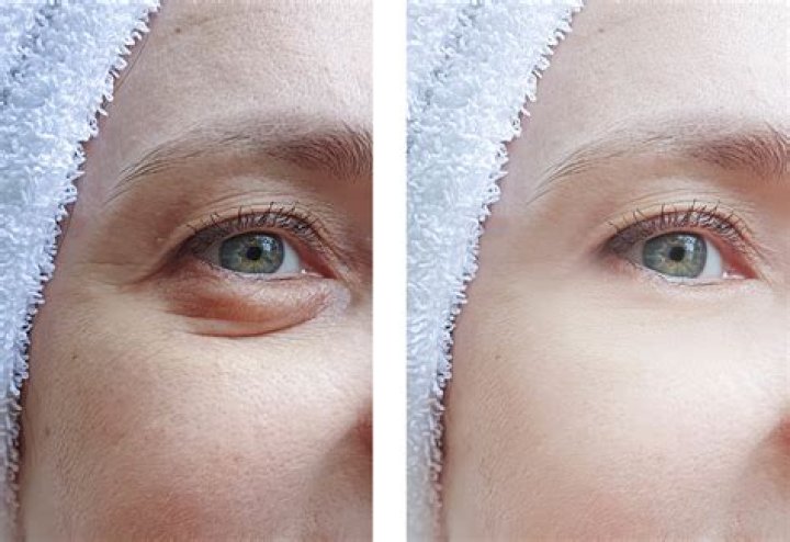 Is ginger good for under eye bags?