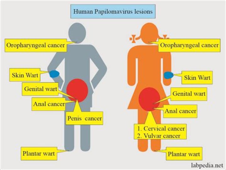 Is HPV contagious forever?