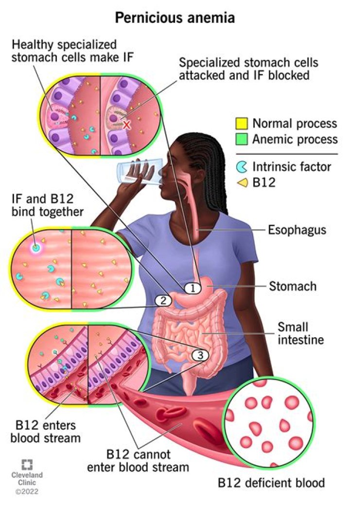 Is pernicious anemia a disability?