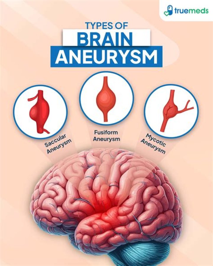 What age do brain aneurysms occur?