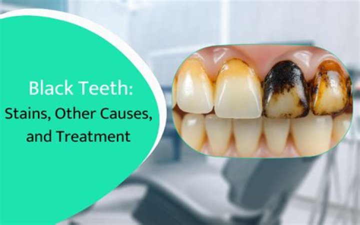 What causes black teeth?