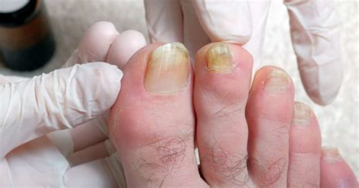What causes thick yellow toenails?