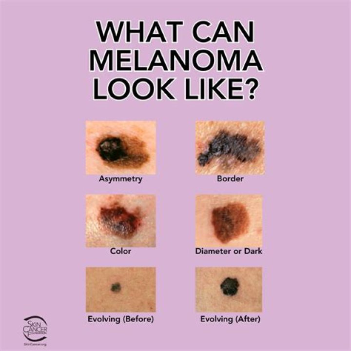 What did your nodular melanoma look like?
