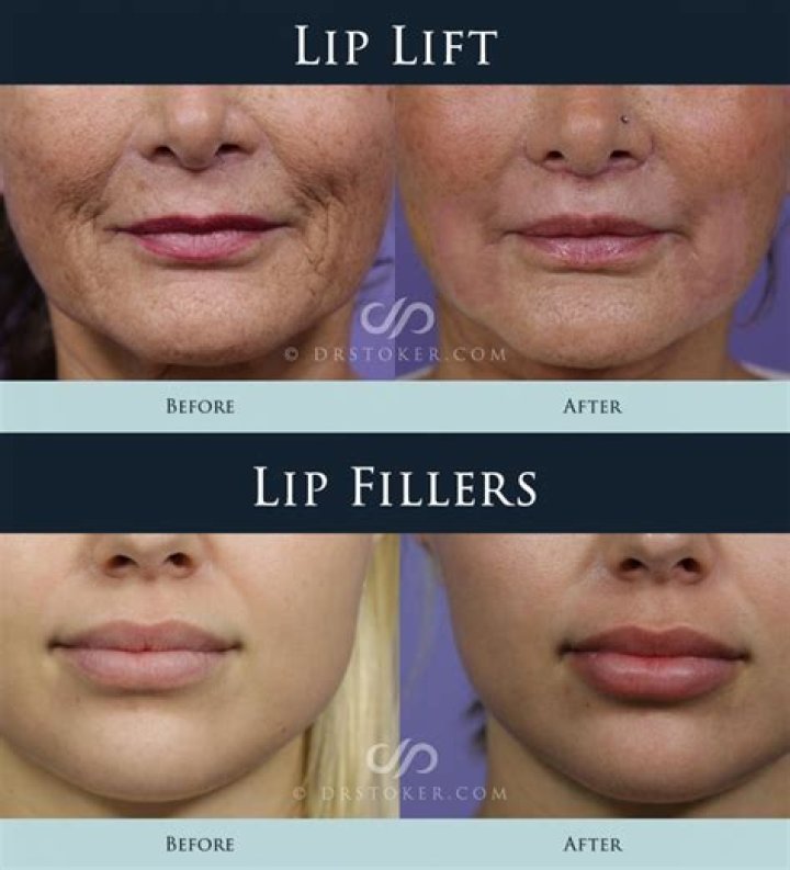 What does a lip lift do?