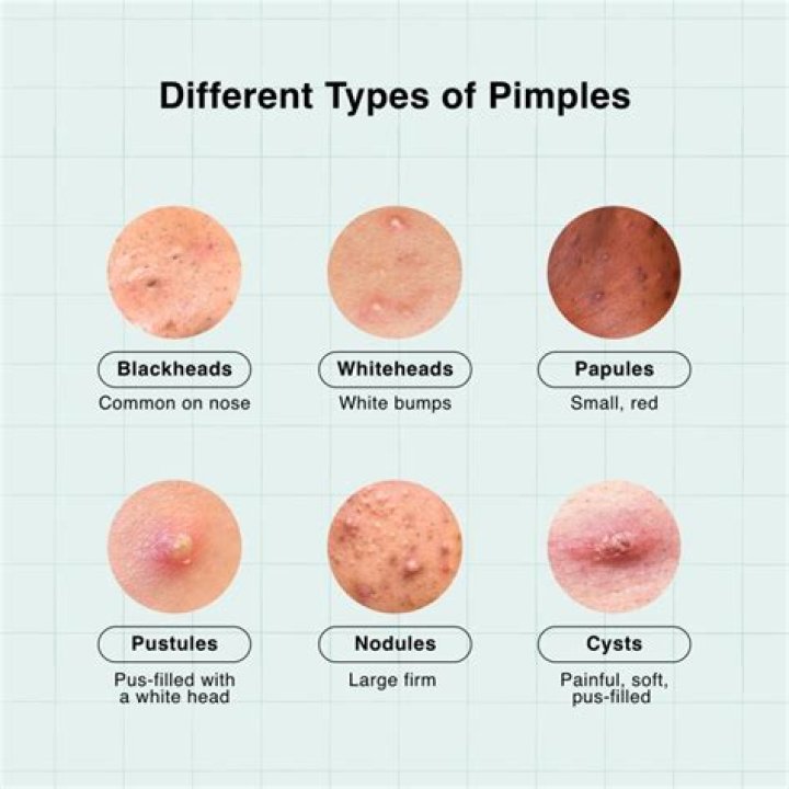 What happens if pimple pus gets in your eye?