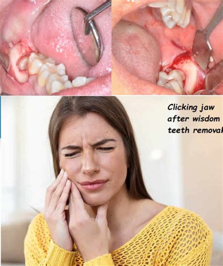 What happens if wisdom tooth hits nerve?