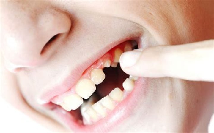 What happens if you don't remove broken tooth?