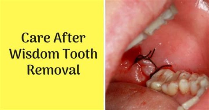 What happens if you leave wisdom teeth in?