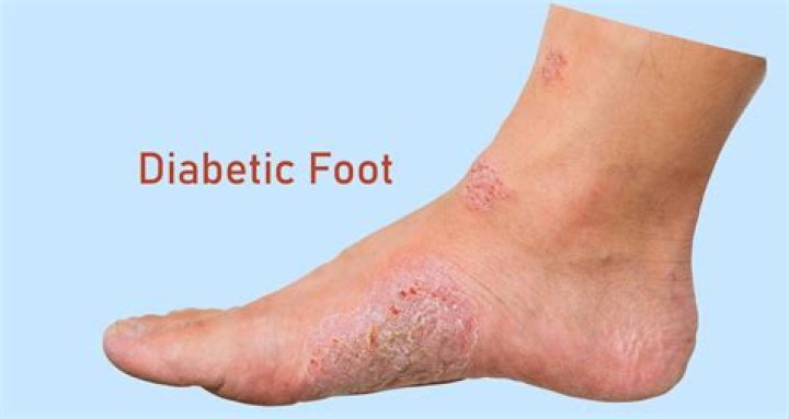 What is diabetic leg pain like?