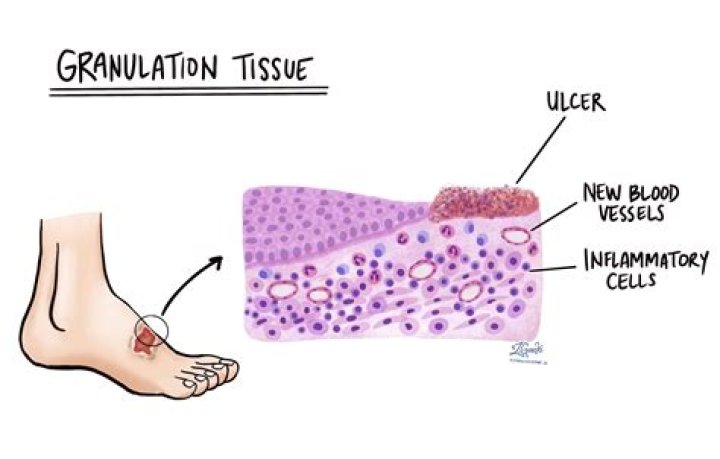 What is granulation tissue?