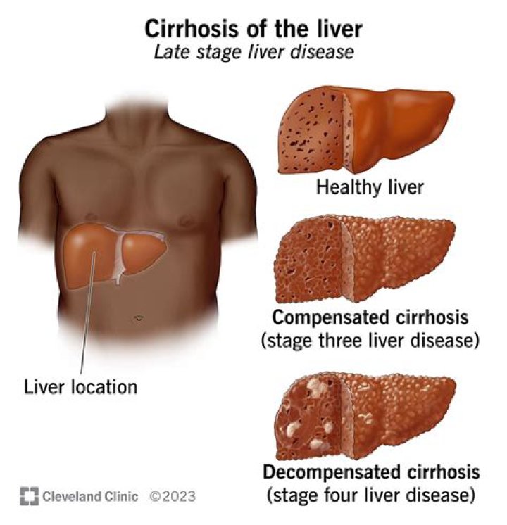 What is the life expectancy of someone with cirrhosis of the liver?