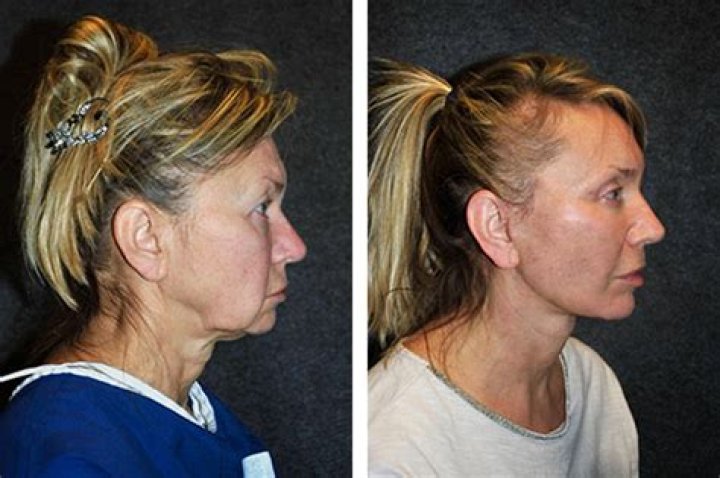 What is the ponytail facelift?