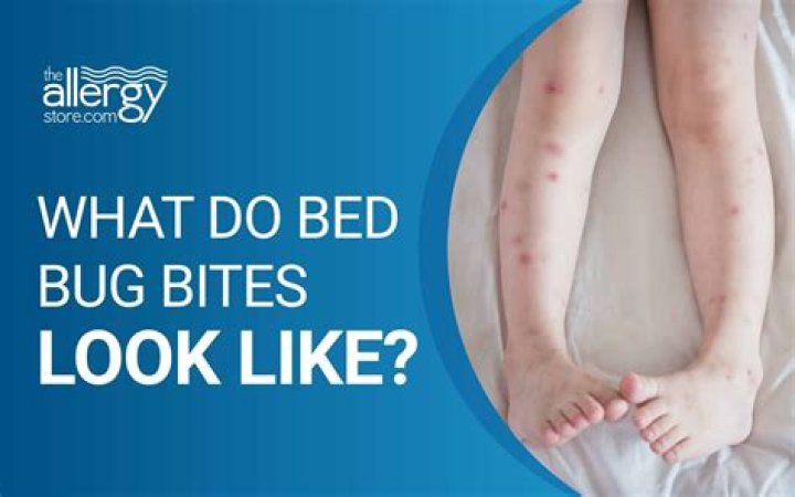 What skin condition looks like bed bug bites?