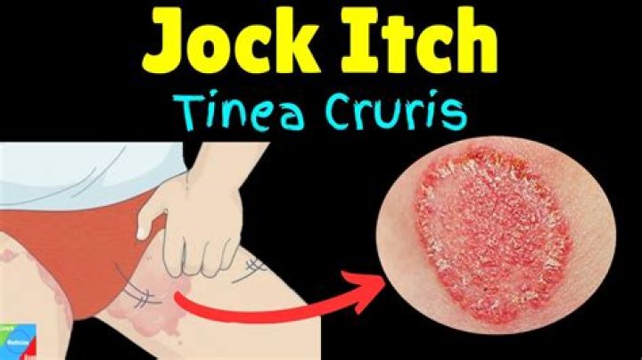 Where do lice itch the most?