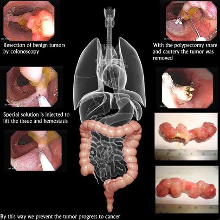 Will I feel better after colon polyp removal?